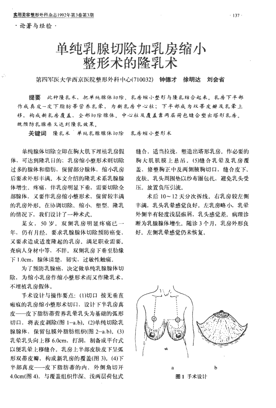 期刊单纯乳腺切除加乳房缩小整形术的隆乳术被引量:2      此种隆乳