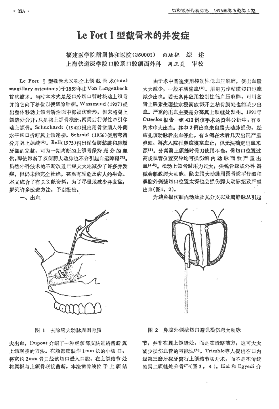 期刊le fort Ⅰ型截骨术的并发症被引量:1      le fort i型截骨术又