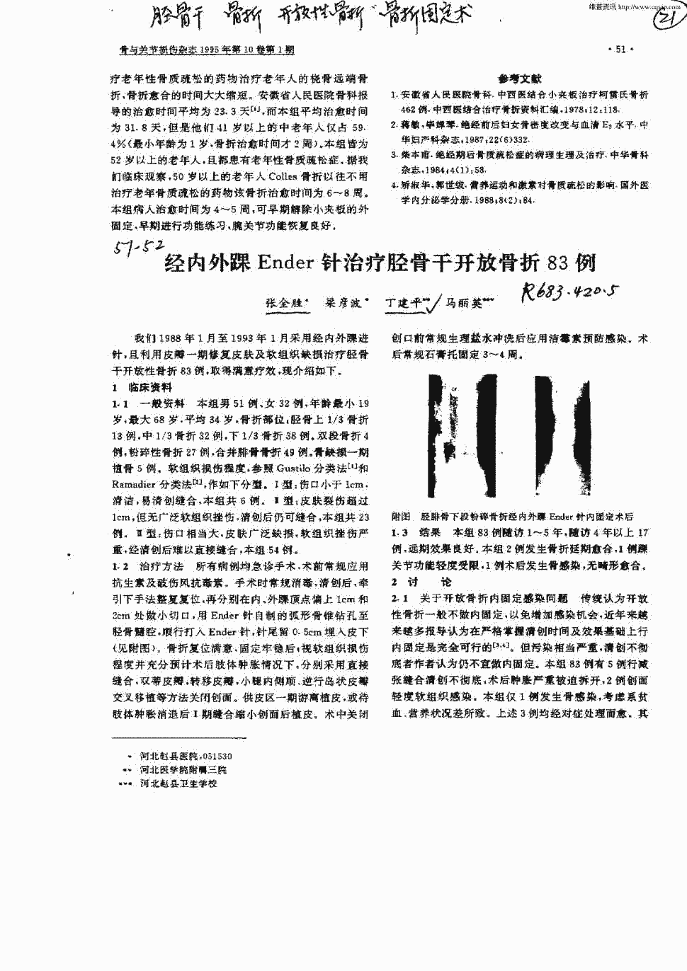 期刊经内外踝ender针治疗胫骨干开放骨折83例被引量:2       正>我们