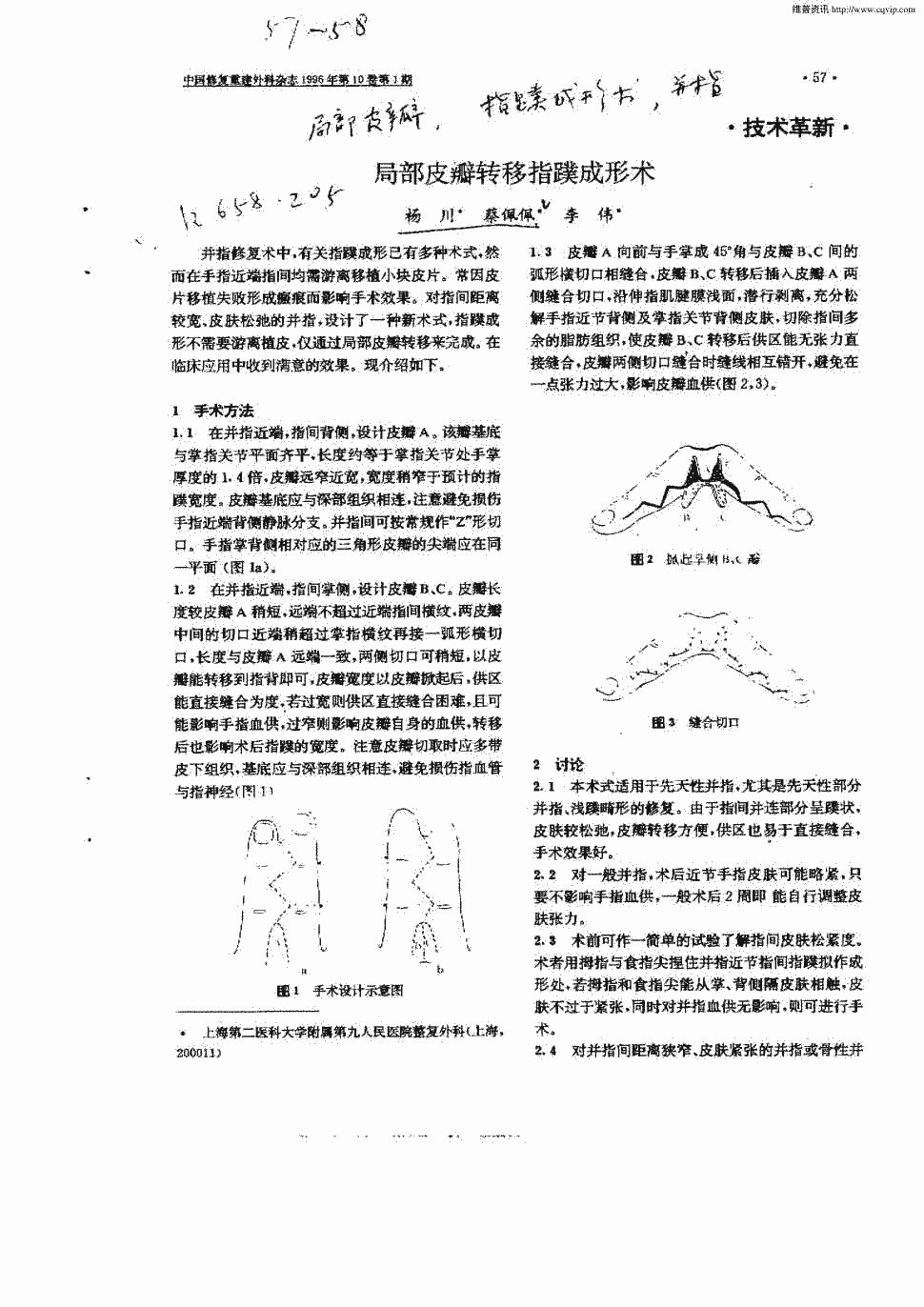 期刊局部皮瓣转移指蹼成形术被引量:2    局部皮瓣转移指蹼成形术