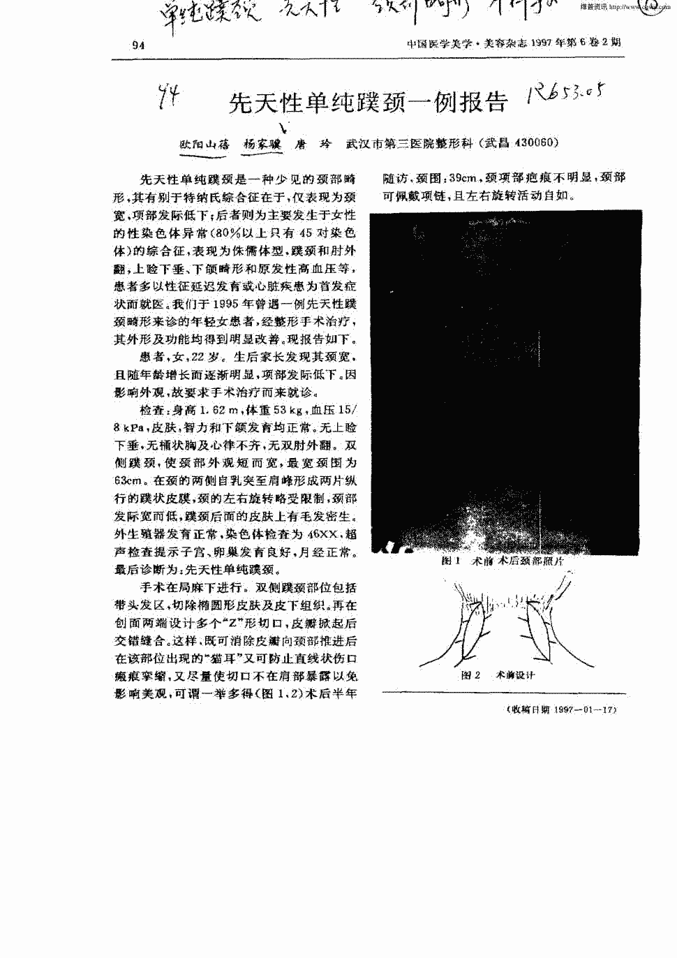 期刊先天性单纯蹼颈一例报告     正> 先天性单纯蹼颈是一种少见的