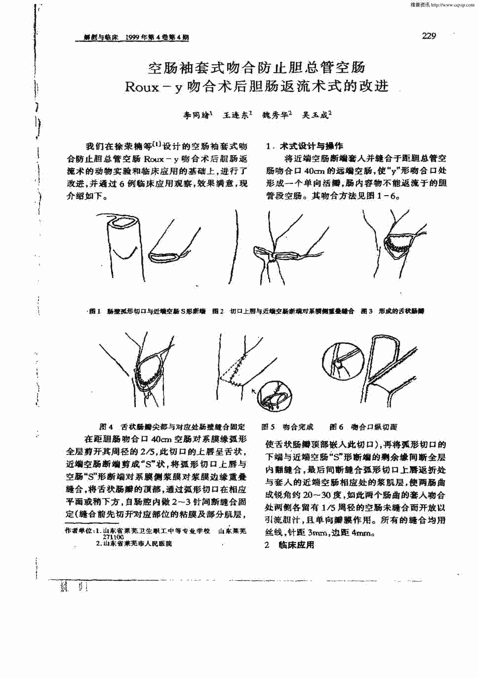 期刊空肠袖套式吻合防止胆总管空肠roux—y吻合术后胆肠返流术式的