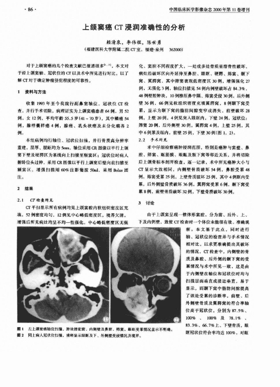 期刊上颌窦癌ct浸润准确性的分析 