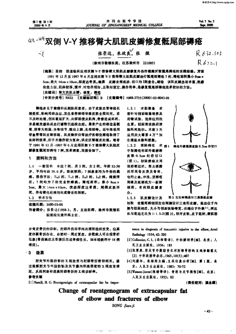 期刊双侧v—y推移臀大肌肌皮瓣修复骶尾部褥疮    目的  报道临床