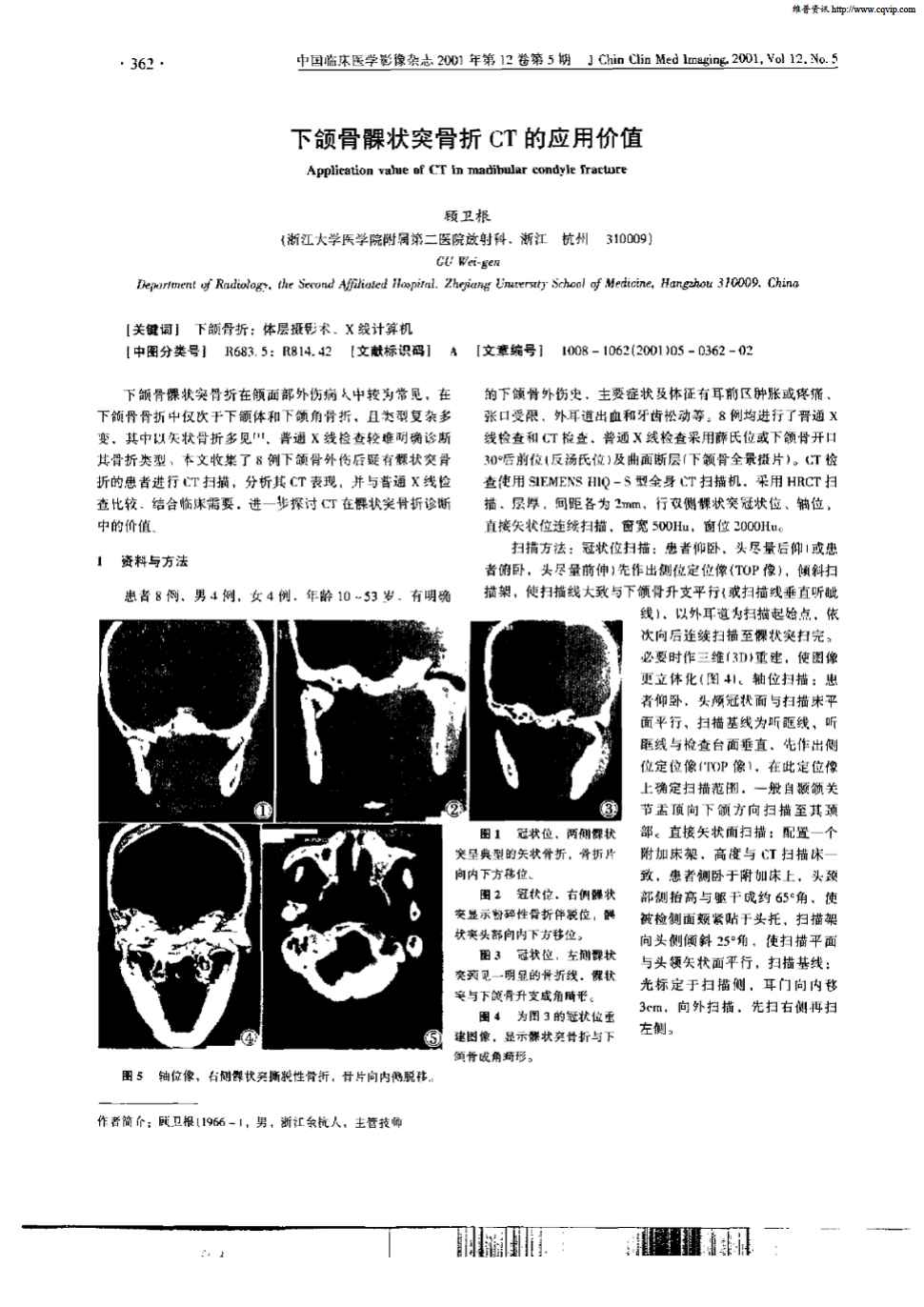 下颌骨髁状突骨折在颌面部外伤病人中较为常见,在下颌骨骨折中仅次于