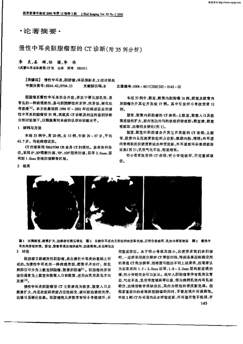 本文收集我院1996年～2001年经病理证实的慢性中耳炎胆脂瘤型35例,现