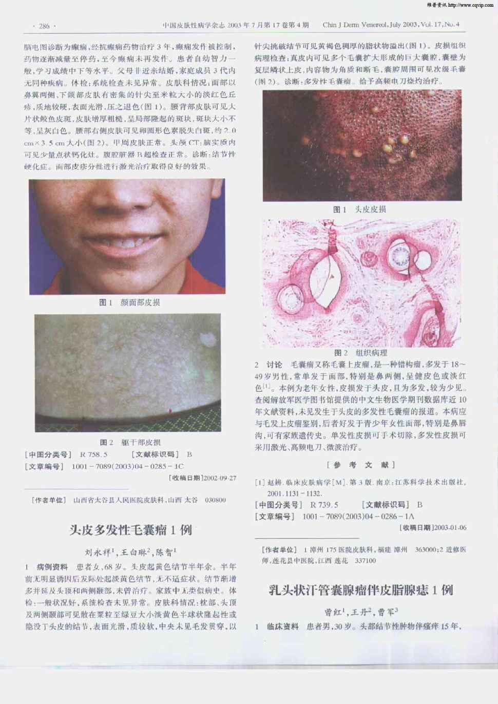 期刊头皮多发性毛囊瘤1例被引量:2     1病例资料患者女,68岁.