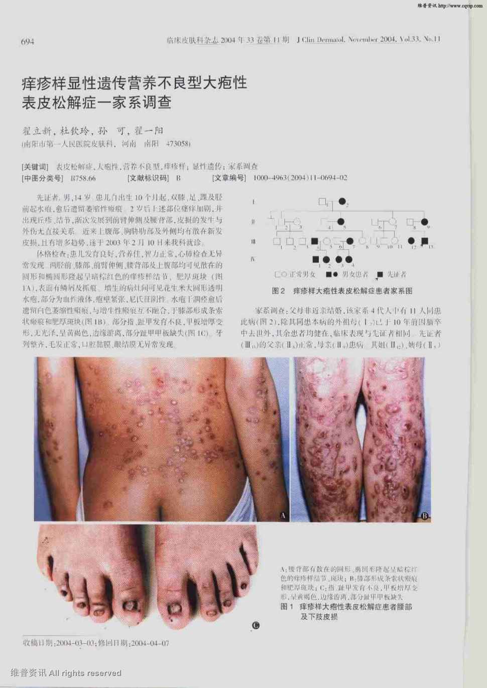 期刊痒疹样显性遗传营养不良型大疱性表皮松解症一家系调查被引量:4