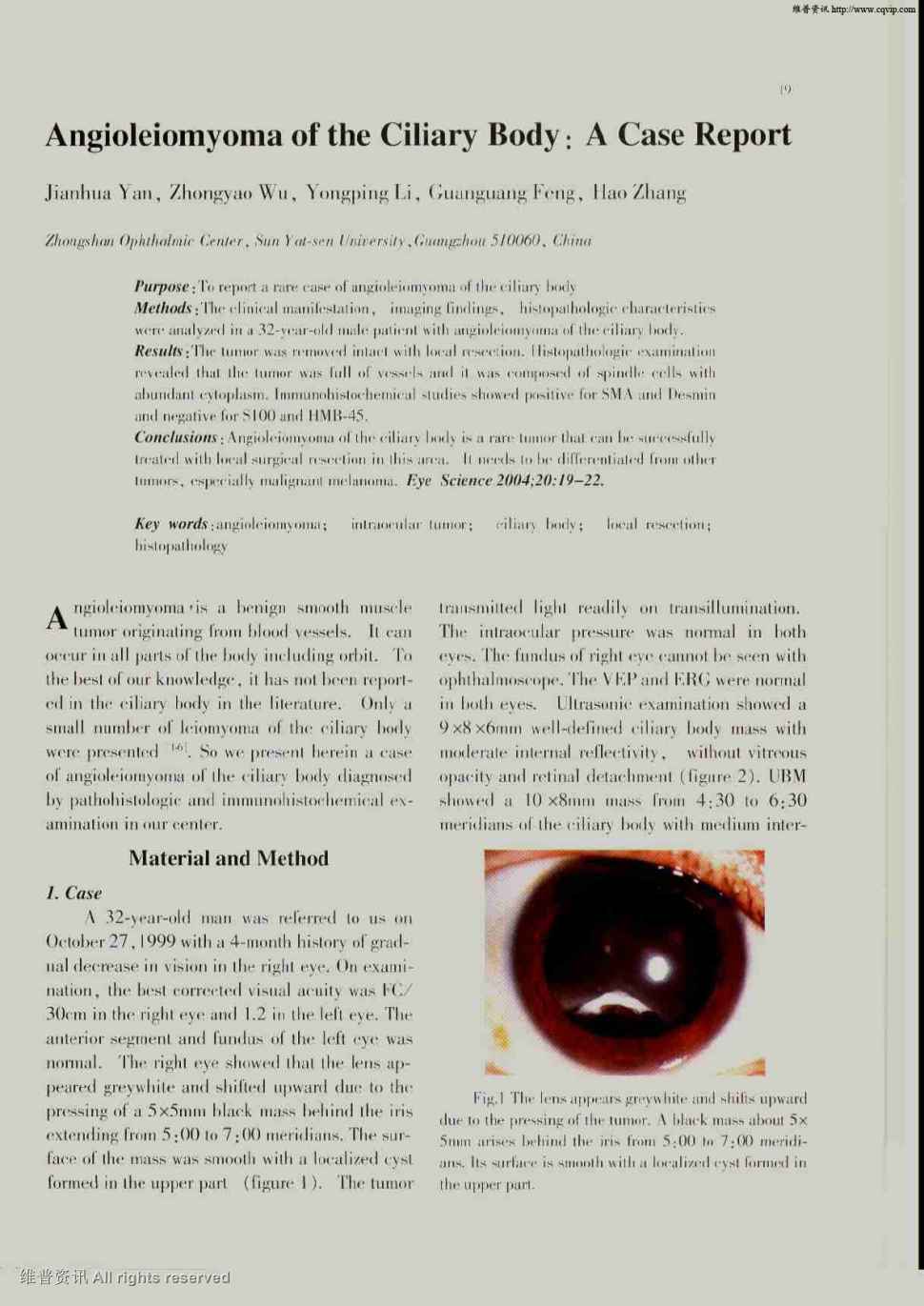 期刊angioleiomyoma of the ciliary body : a case report