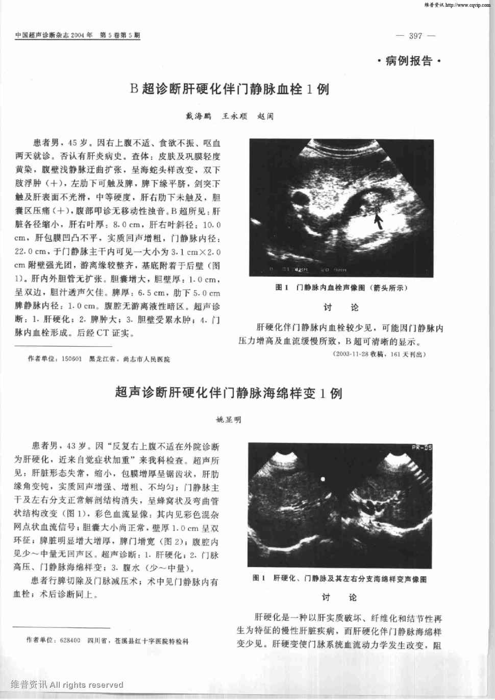 查体:皮肤及巩膜轻度黄染,腹壁浅静脉迂曲扩张,呈海蛇头样改变,双下肢