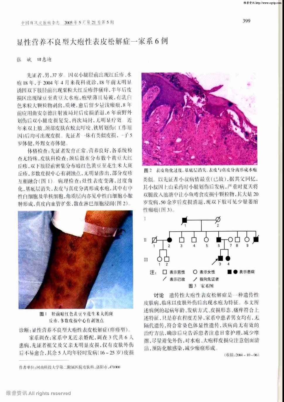 期刊显性营养不良型大疱性表皮松解症一家系6例被引量:1    先证者