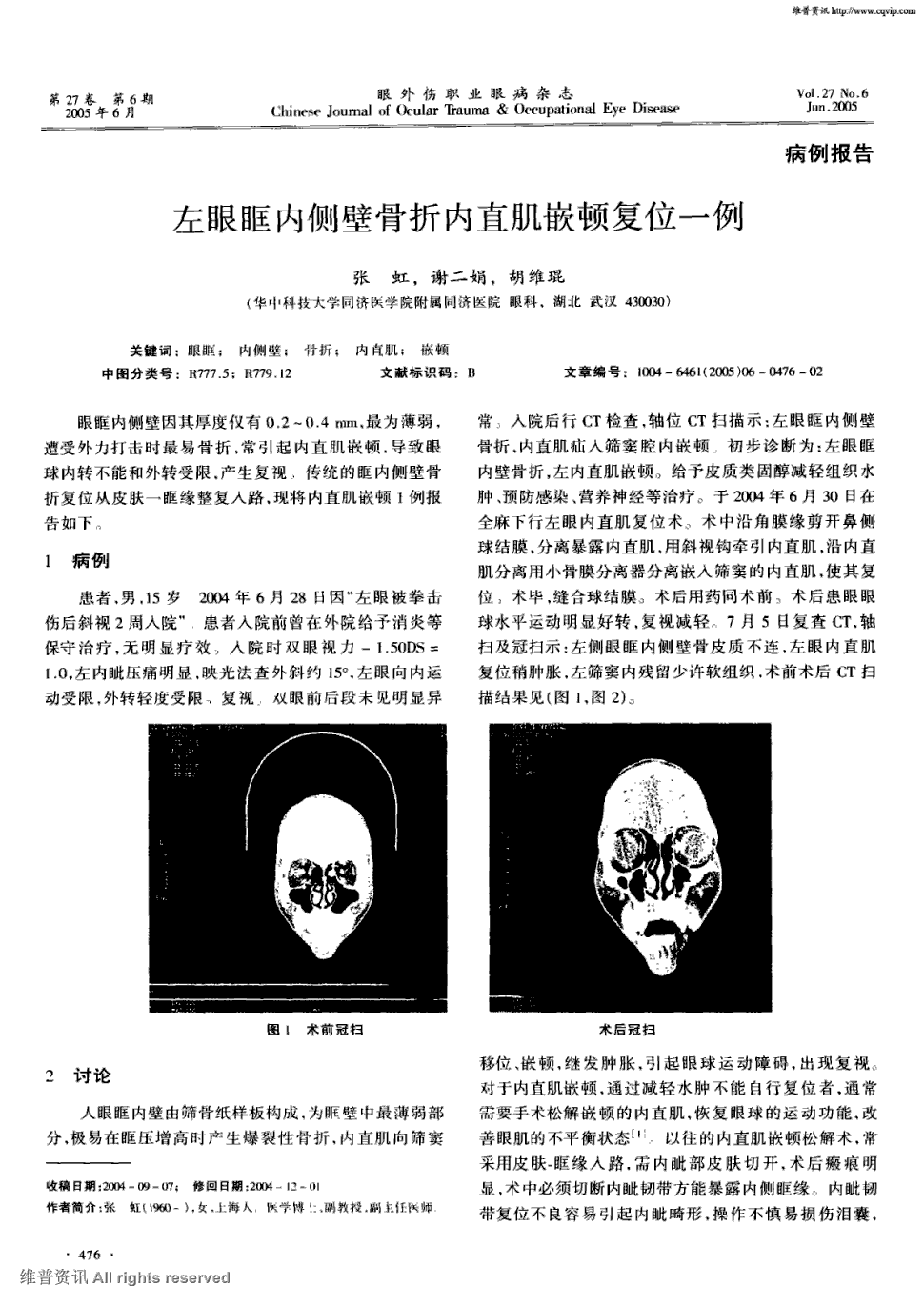 期刊左眼眶内侧壁骨折内直肌嵌顿复位一例被引量:1     眼眶内侧壁因