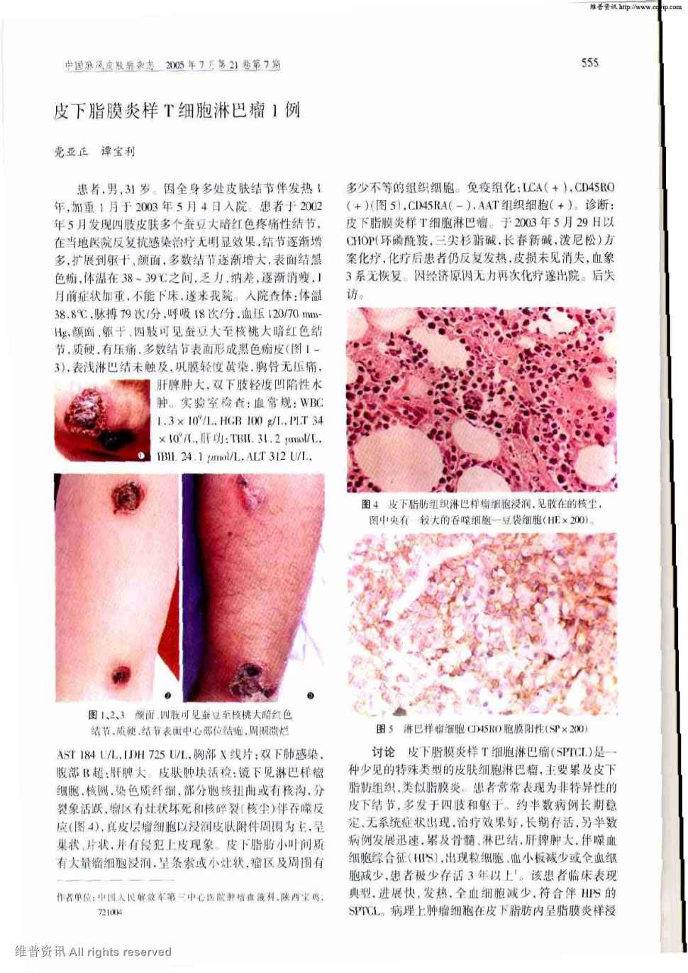 期刊皮下脂膜炎样t细胞淋巴瘤1例    患者,男,31岁.