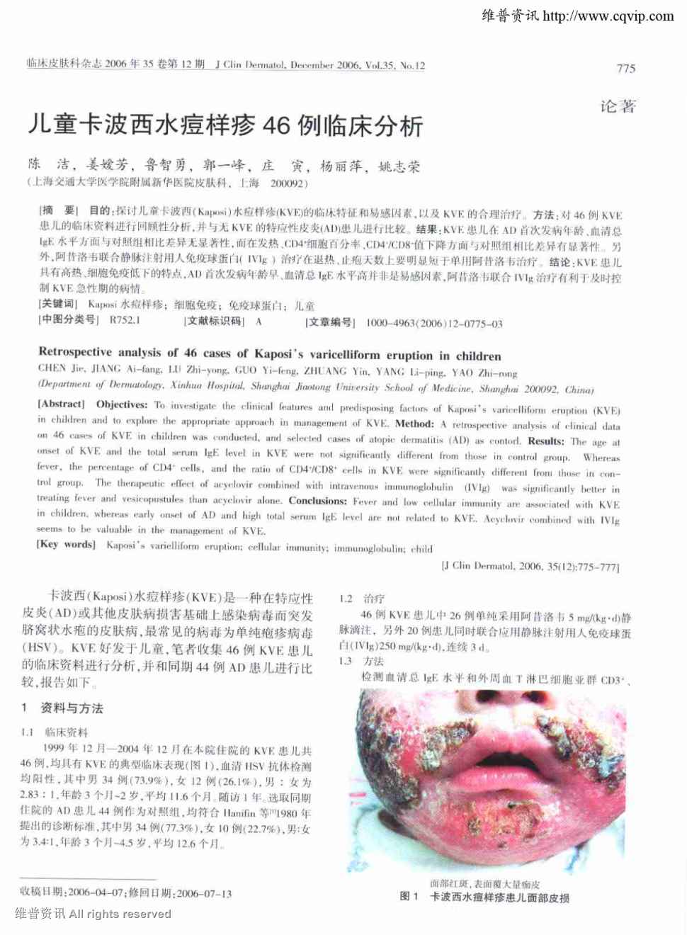 期刊儿童卡波西水痘样疹46例临床分析被引量:10         目的:探讨