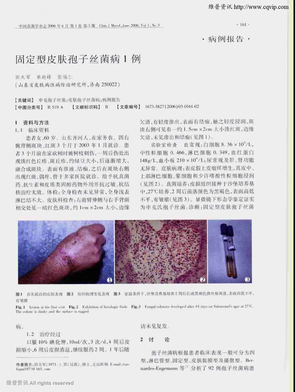 期刊固定型皮肤孢子丝菌病1例     1 资料与方法  1.
