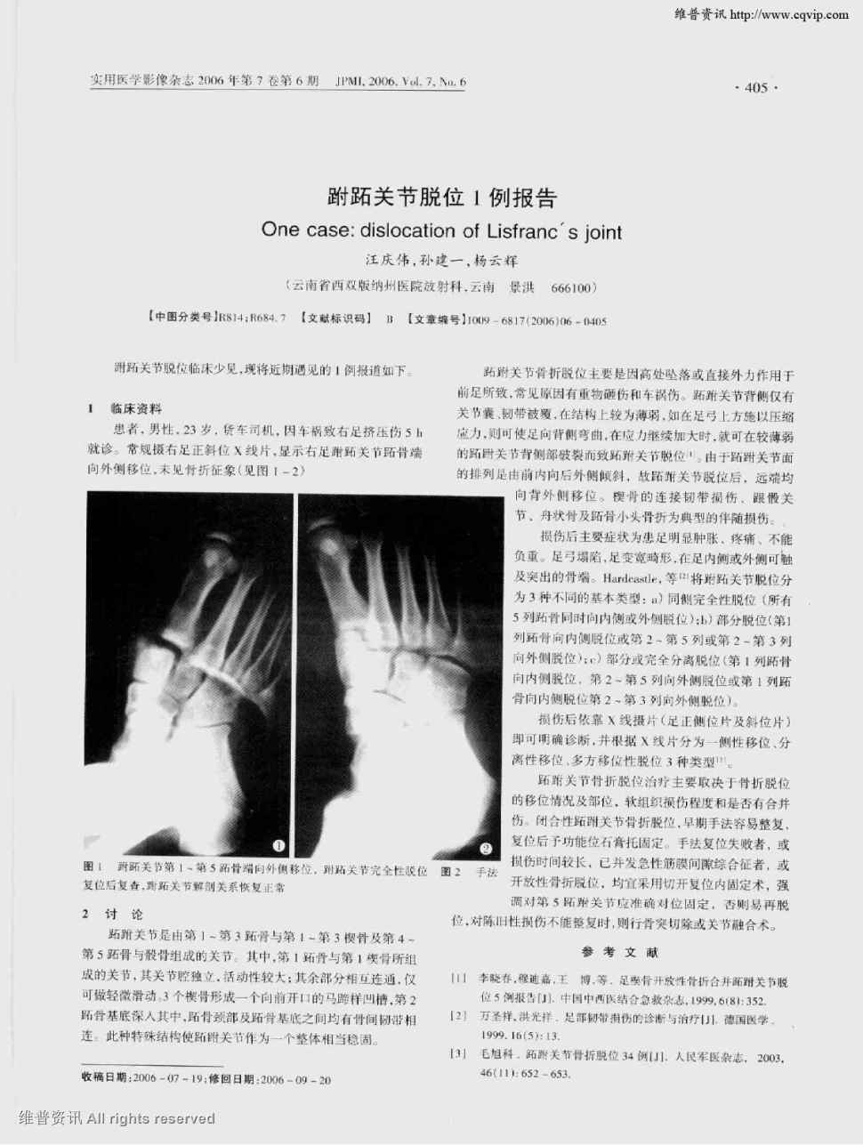 期刊跟骨骨折跗跖关节脱位致足筋膜室综合征造成小腿截肢1例报告被引