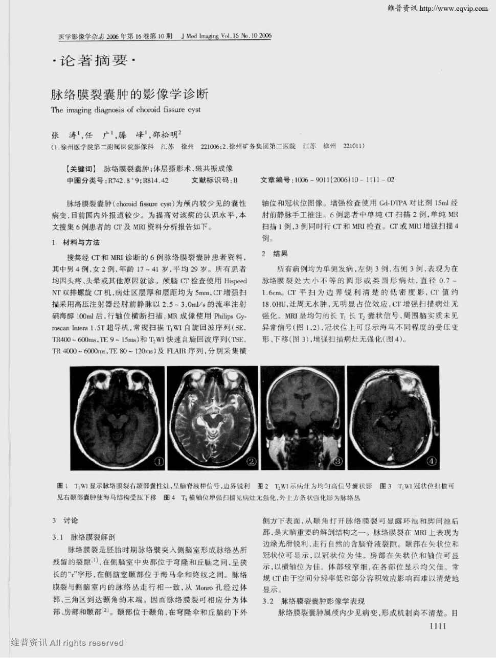 期刊脉络膜裂囊肿的影像学诊断 脉络膜裂囊肿(choroid fissure cyst)