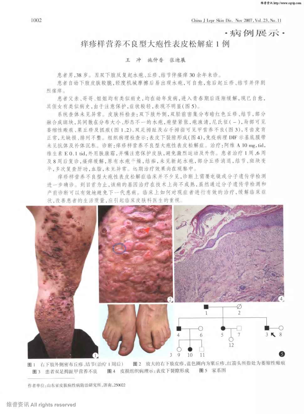 期刊痒疹样营养不良型大疱性表皮松解症1例     患者男,38岁.