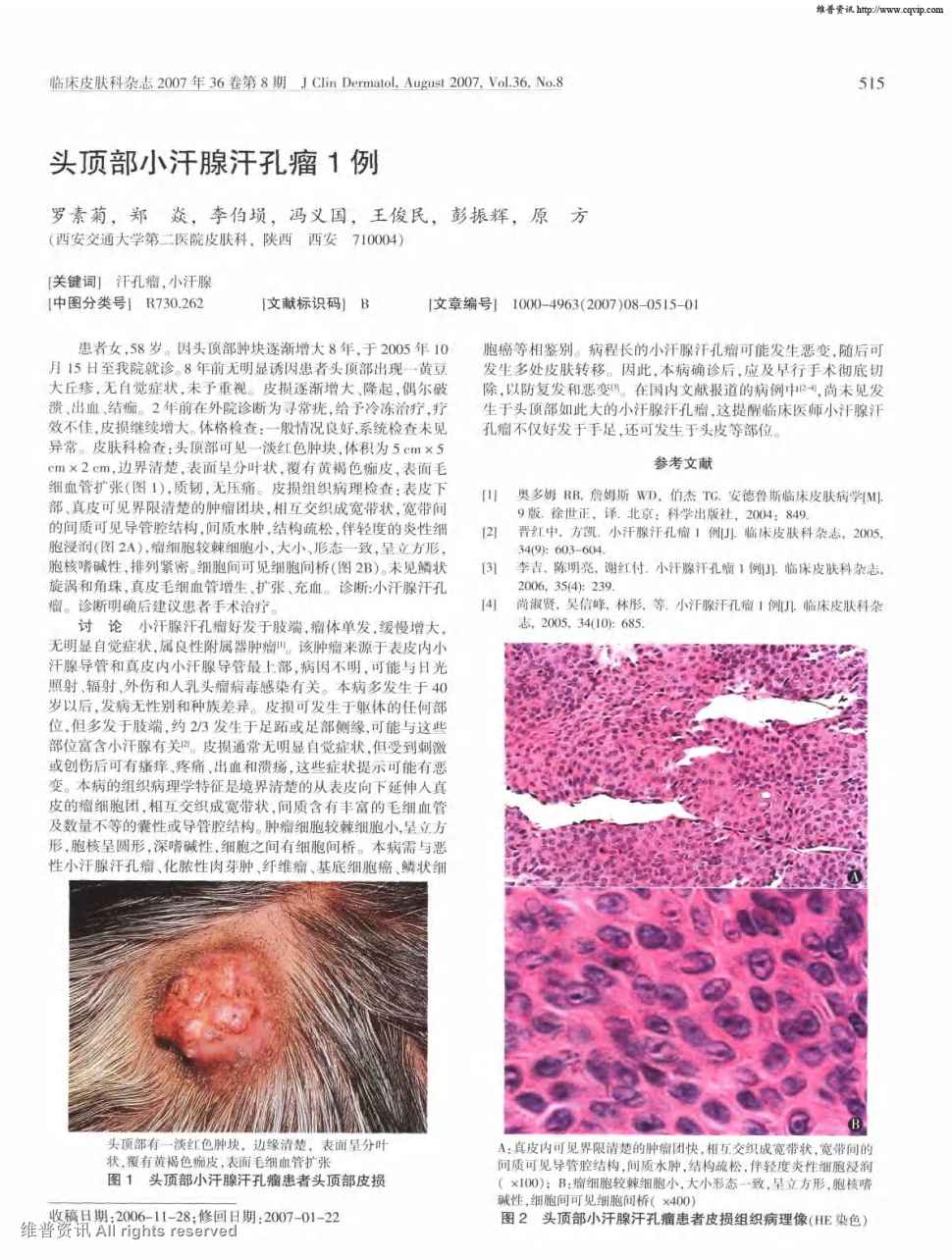 期刊头顶部小汗腺汗孔瘤1例被引量:6         患者女,58岁,因头顶部