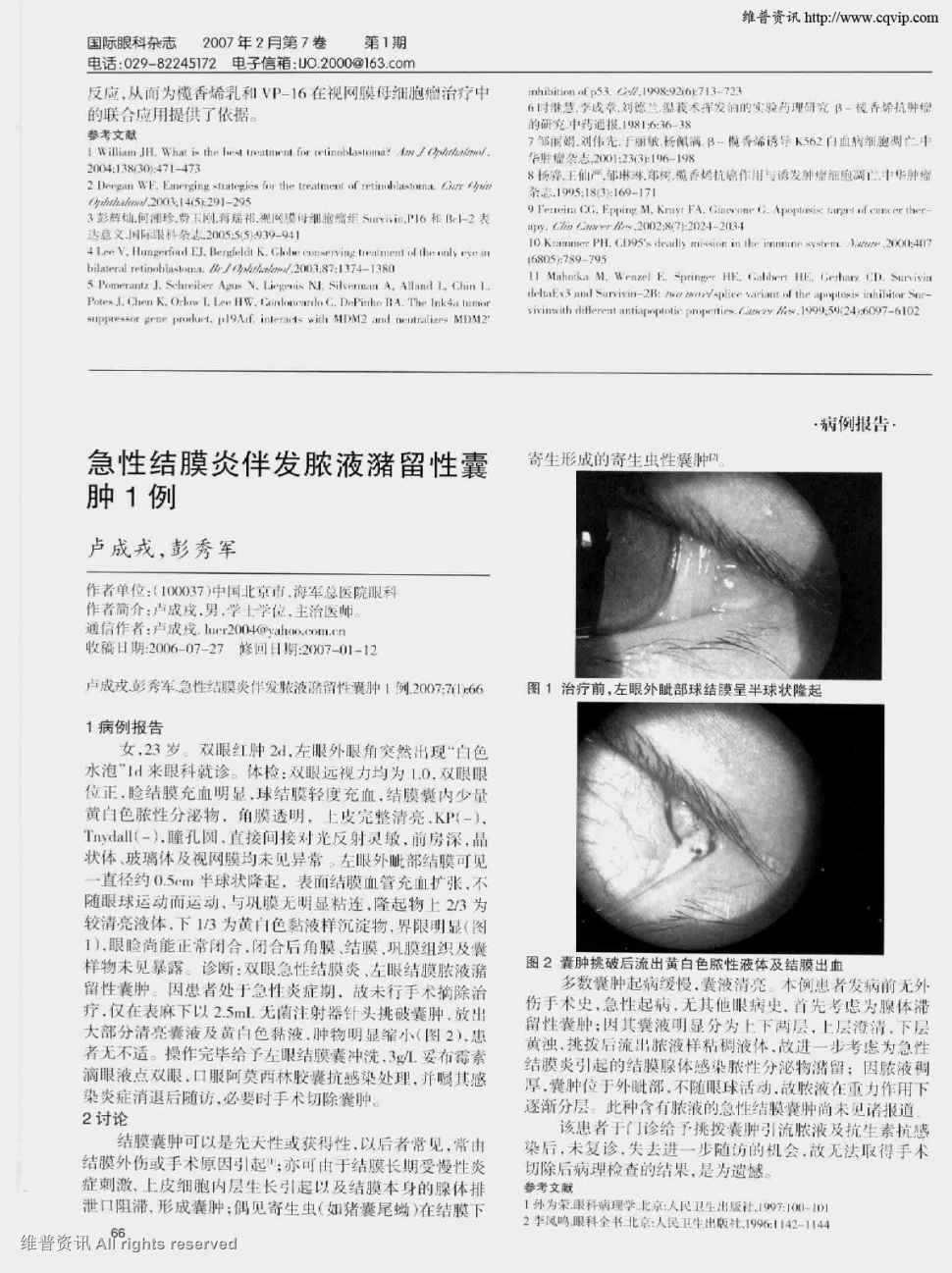 期刊急性结膜炎伴发脓液潴留性囊肿1例    1病例报告女,23岁.