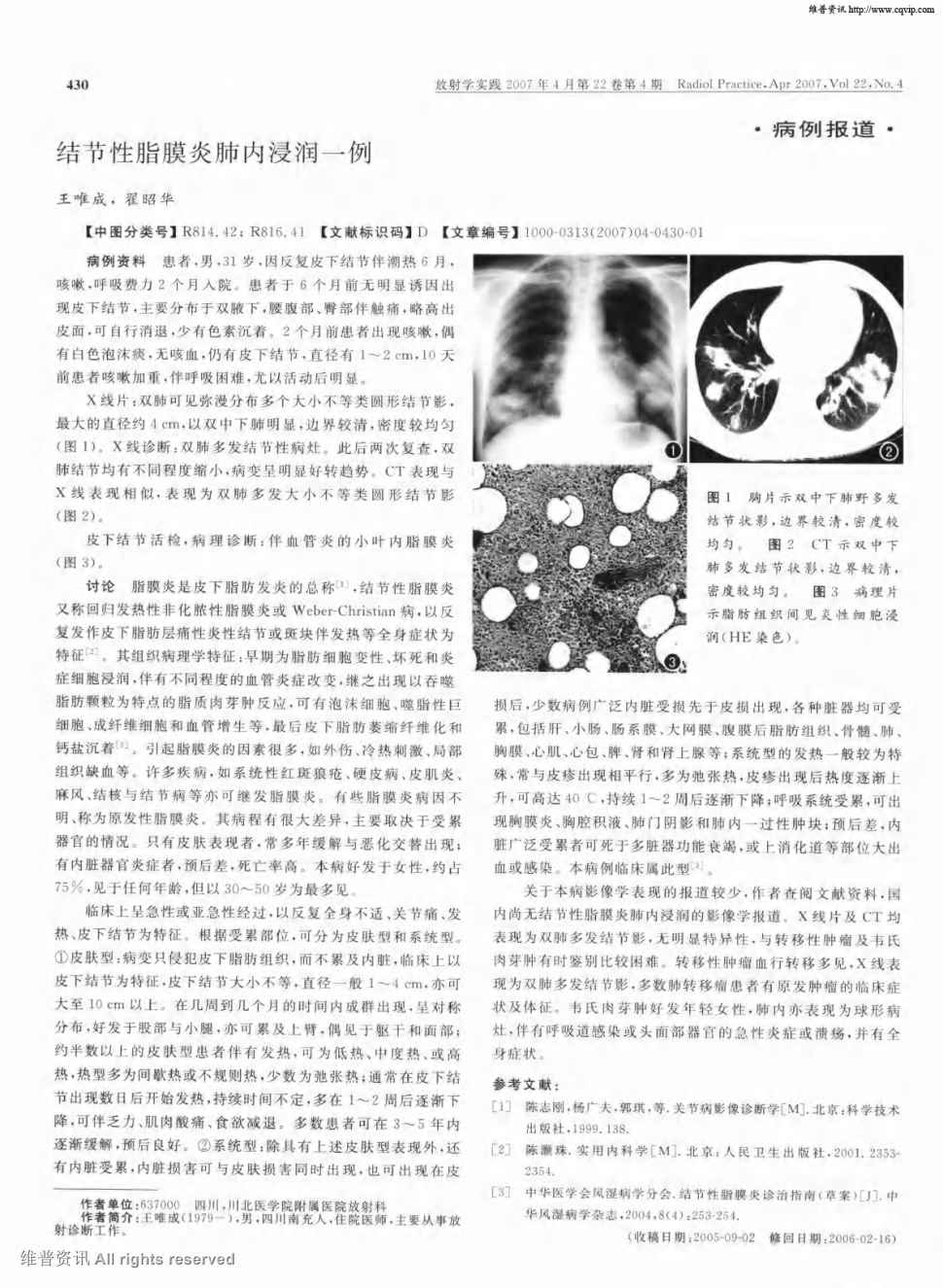 期刊结节性脂膜炎肺内浸润一例被引量:2    病例资料 患哌.