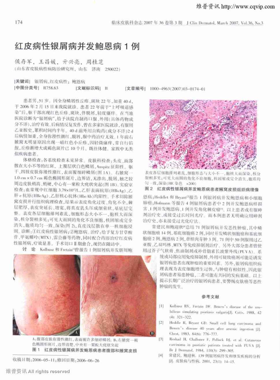 期刊红皮病性银屑病并发鲍恩病1例被引量:1      患者男,51岁.