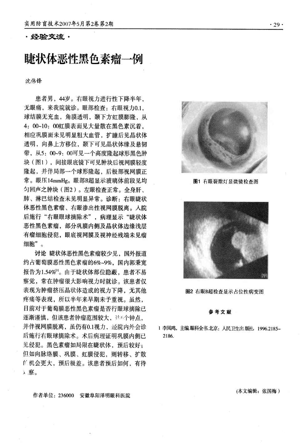 角膜透明,颞下方虹膜膨隆,从4:00～10:00虹膜表面见大量散在黑色素沉