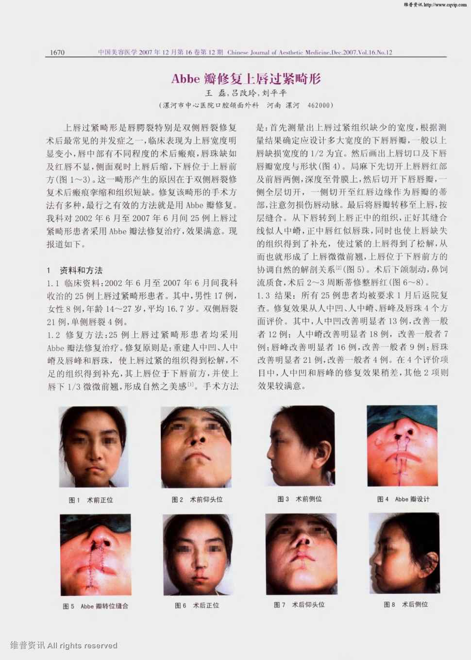 上唇过紧畸形是唇腭裂特别是双侧唇裂修复术后最常见的并发症之一