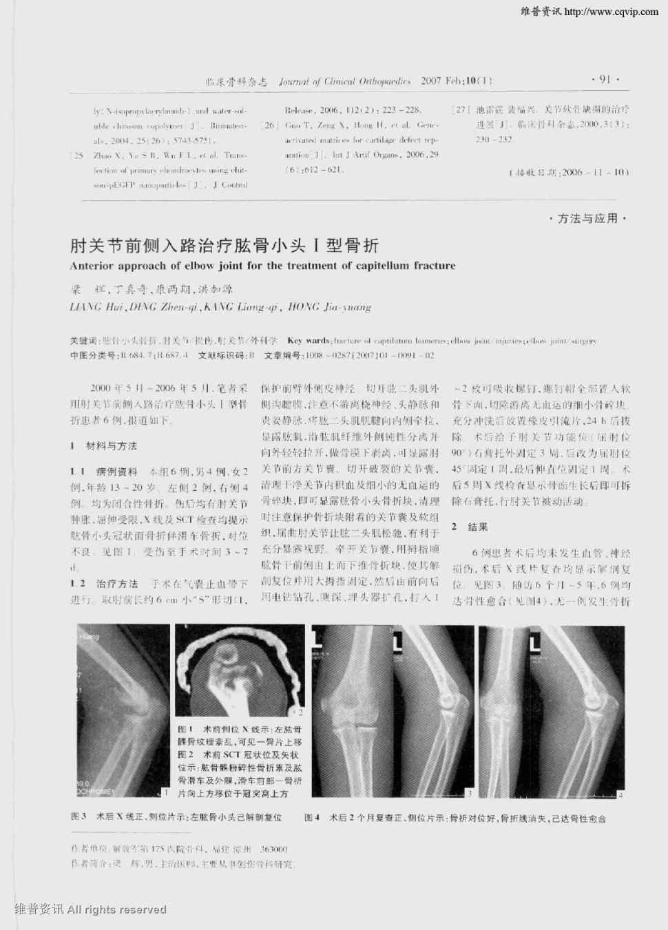 期刊肘关节前侧入路治疗肱骨小头Ⅰ型骨折被引量:1      2000年5月