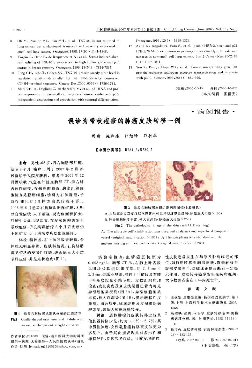 期刊误诊为带状疱疹的肺癌皮肤转移一例被引量:1        患者 男性