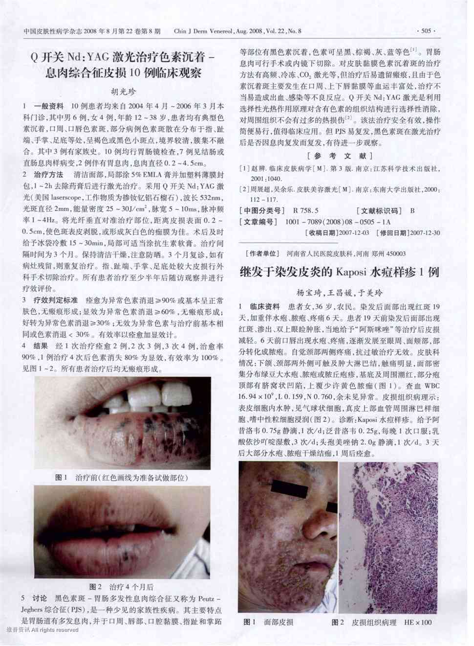 期刊继发于染发皮炎的kaposi水痘样疹1例被引量:4     1临床资料