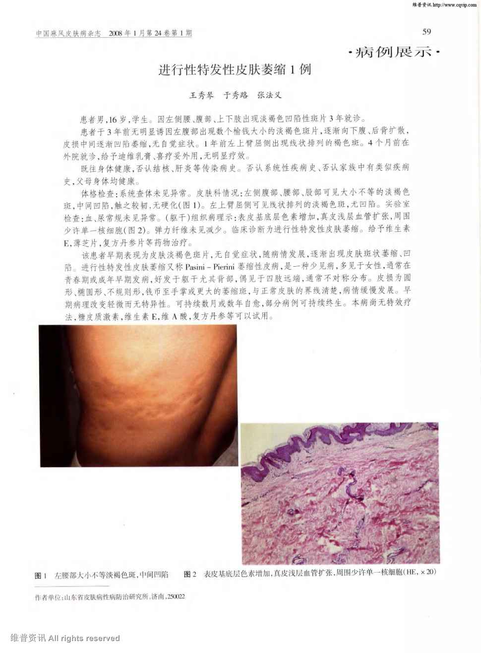 期刊进行性特发性皮肤萎缩1例