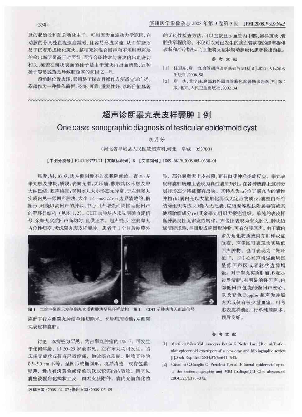 期刊超声诊断睾丸表皮样囊肿1例被引量:1   患者,男,16岁,因左侧阴囊