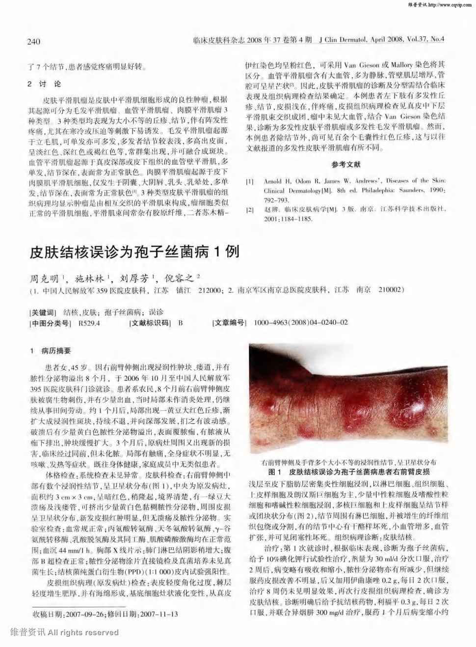 期刊皮肤结核误诊为孢子丝菌病1例被引量:1      1 病历摘要  患者