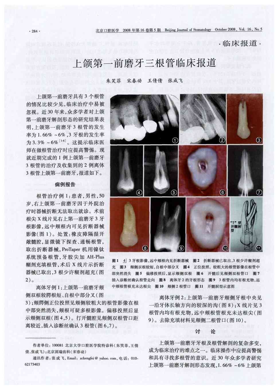 期刊上颌第一前磨牙三根管临床报道被引量:13      上颌第一前磨牙