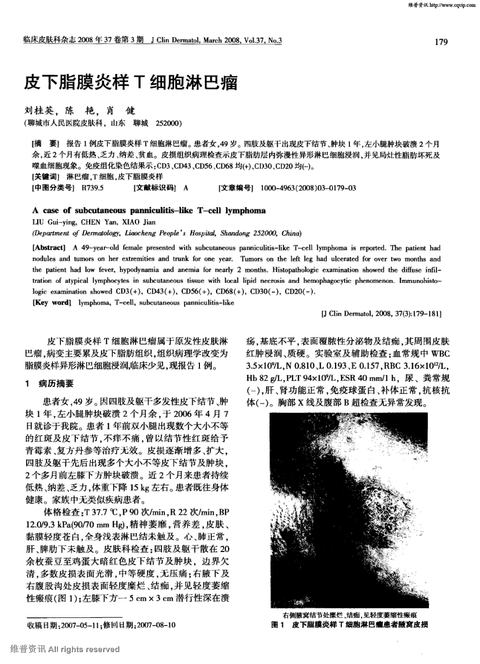 期刊皮下脂膜炎样t细胞淋巴瘤     报告1例皮下脂膜炎样t细胞淋巴瘤.