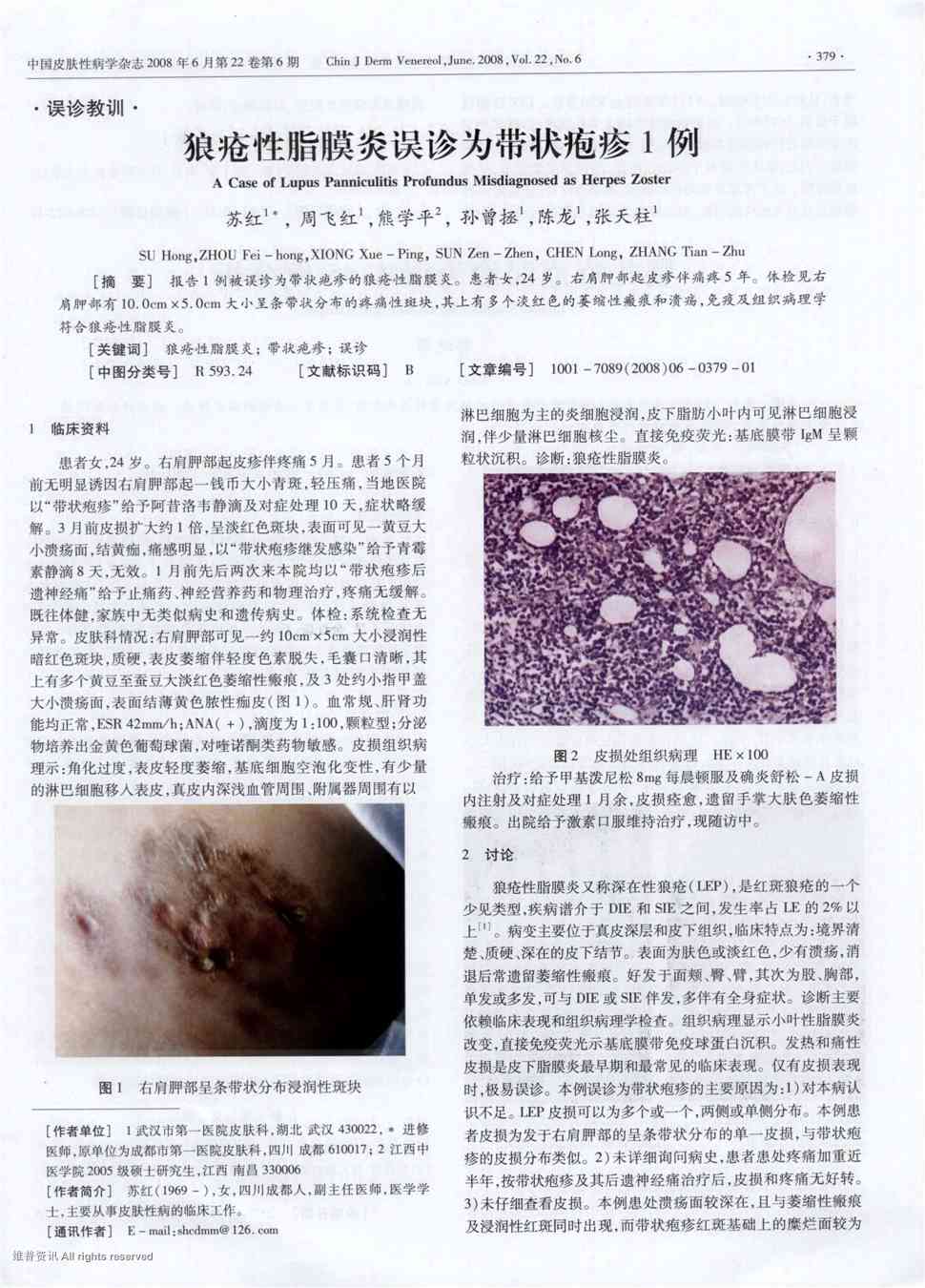 期刊狼疮性脂膜炎误诊为带状疱疹1例被引量:1        报告1例被误诊