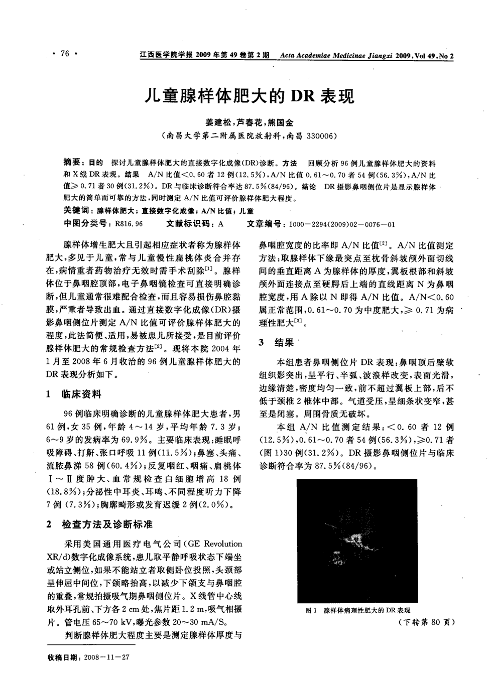 期刊儿童腺样体肥大的dr表现被引量:3     目的探讨儿童腺样体肥大的