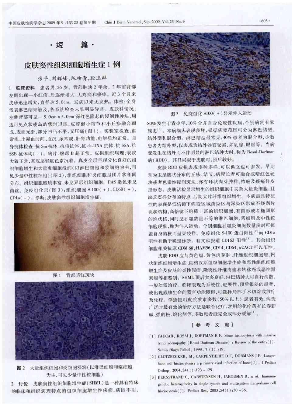 期刊皮肤窦性组织细胞增生症1例被引量:1      1临床资料 患者男,56