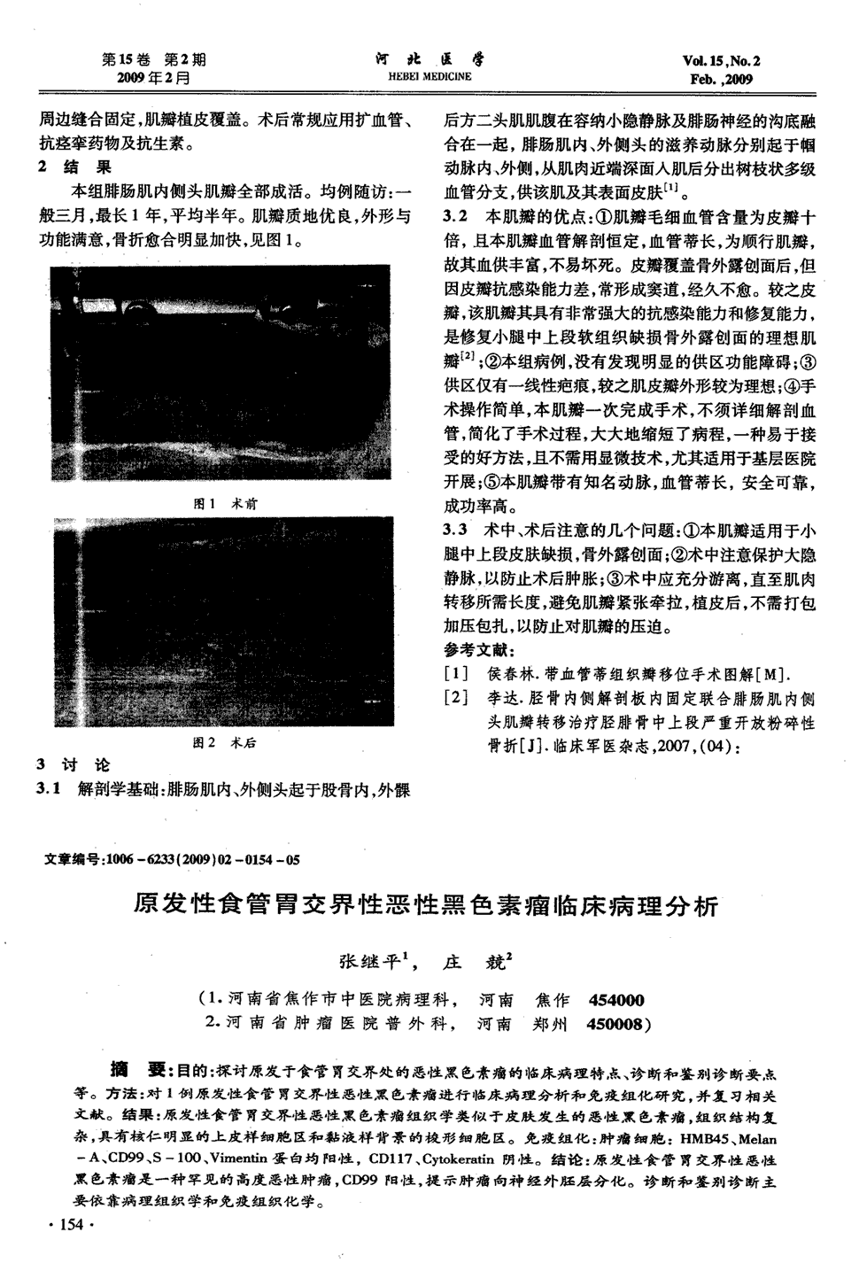 结果:原发性食管胃交界性恶性黑色素瘤组织学类似于.显示全部