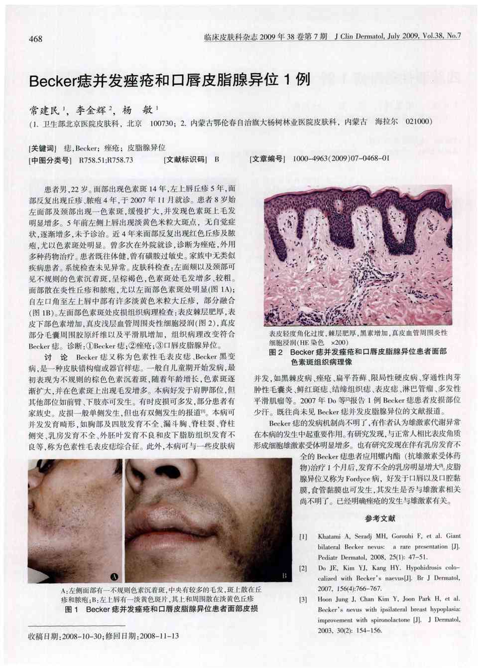 期刊becker痣并发痤疮和口唇皮脂腺异位1例     患者男,22岁.