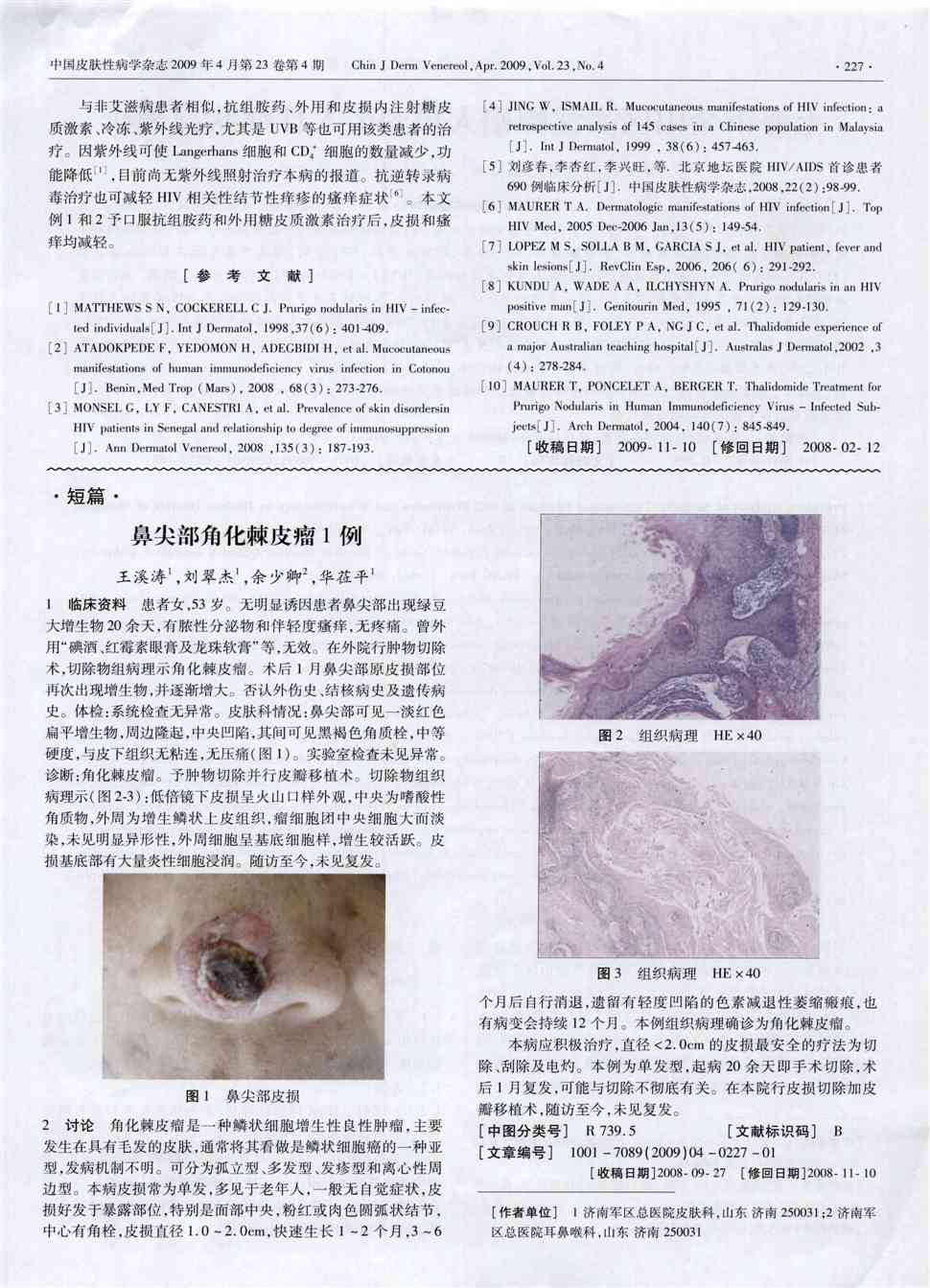期刊鼻尖部角化棘皮瘤1例被引量:4      1 临床资料 患者女,53岁.