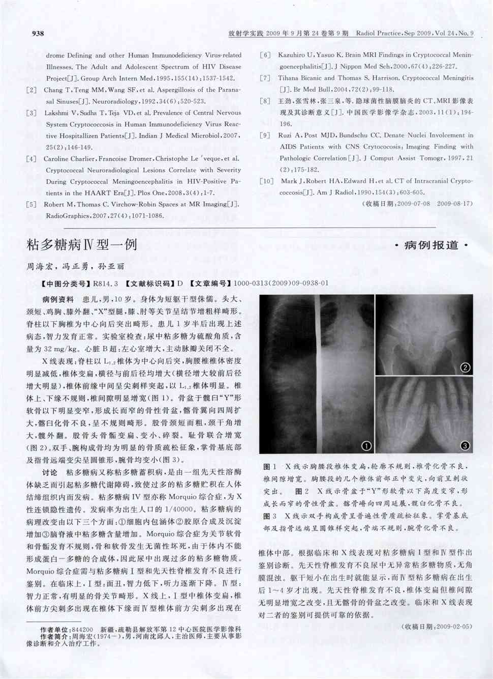 期刊粘多糖病Ⅳ型一例     病例资料患儿,男,10岁.