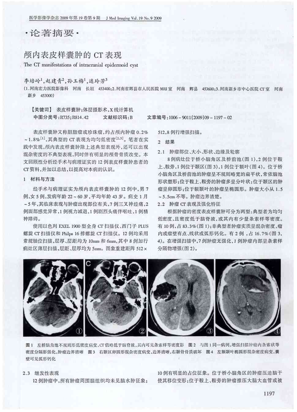 期刊颅内表皮样囊肿的ct表现被引量:2      表皮样囊肿又称胆脂瘤或