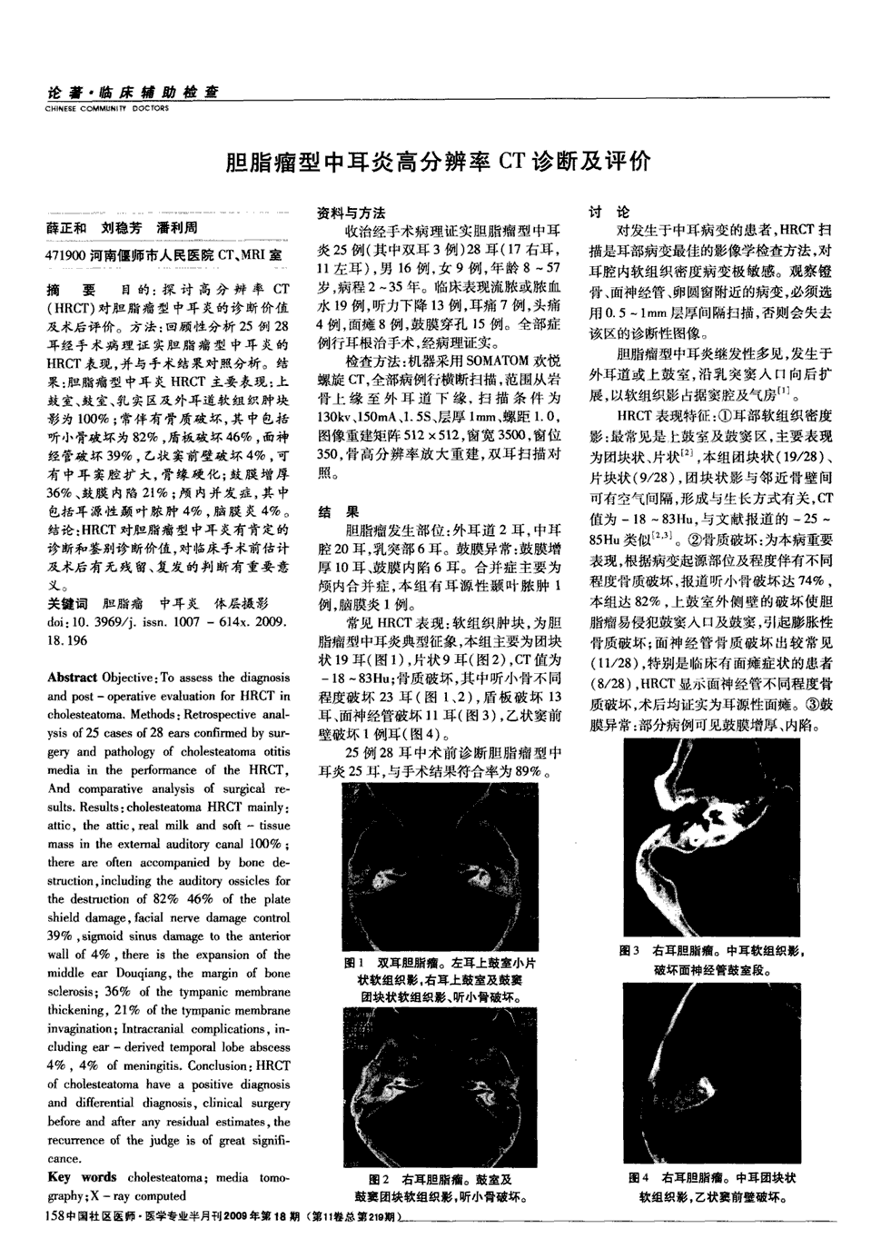 方法:回顾性分析25例28耳经手术病理证实胆脂瘤型中耳炎的hrct表现,并