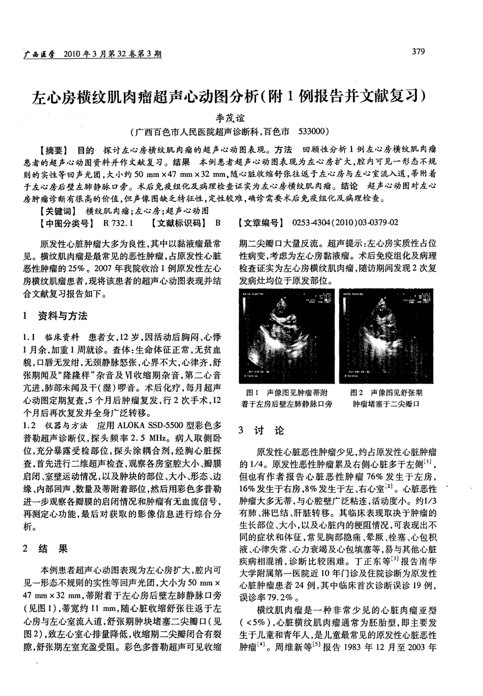 期刊左心房横纹肌肉瘤超声心动图分析(附1例报告并文献复习)被引量:1