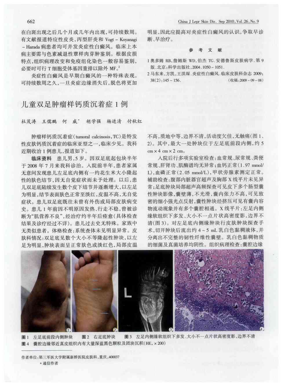 期刊儿童双足肿瘤样钙质沉着症1例