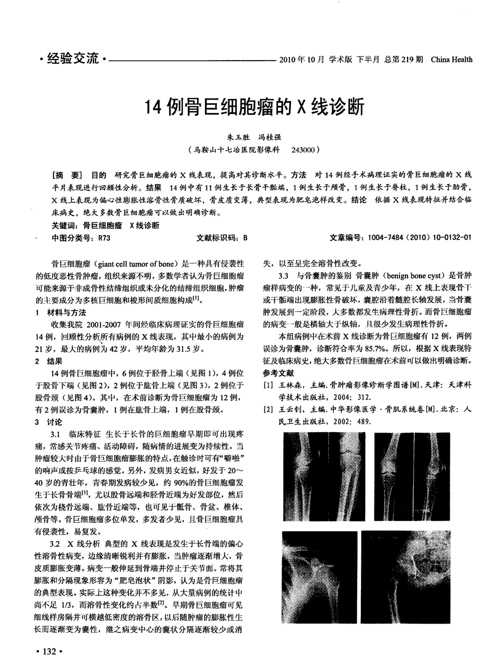 期刊14例骨巨细胞瘤的x线诊断    目的研究骨巨细胞瘤的x线表现,提高