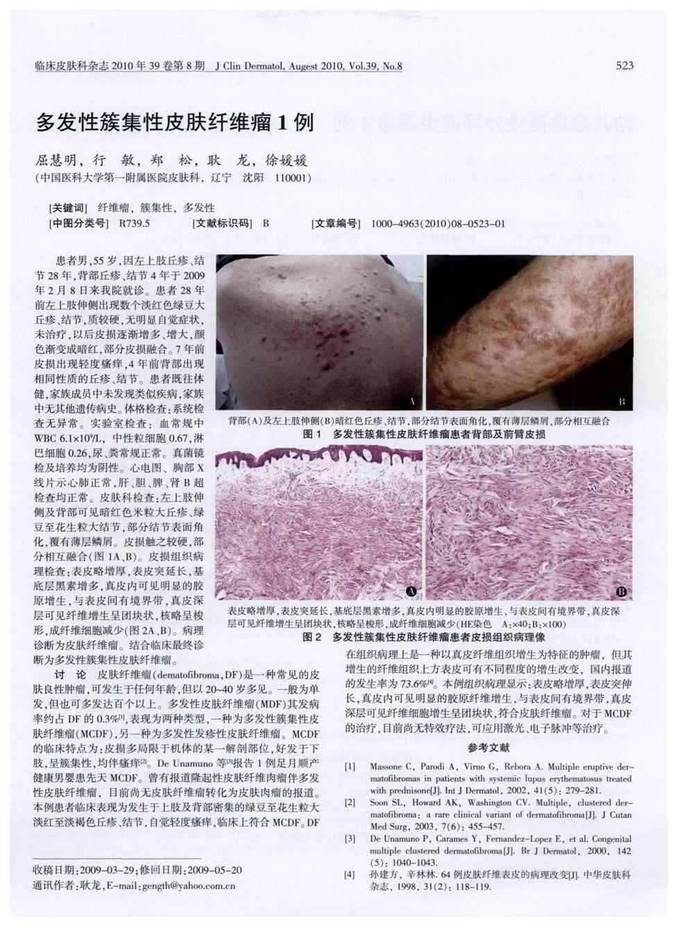 期刊多发性簇集性皮肤纤维瘤1例被引量:1       患者男,55岁,因左