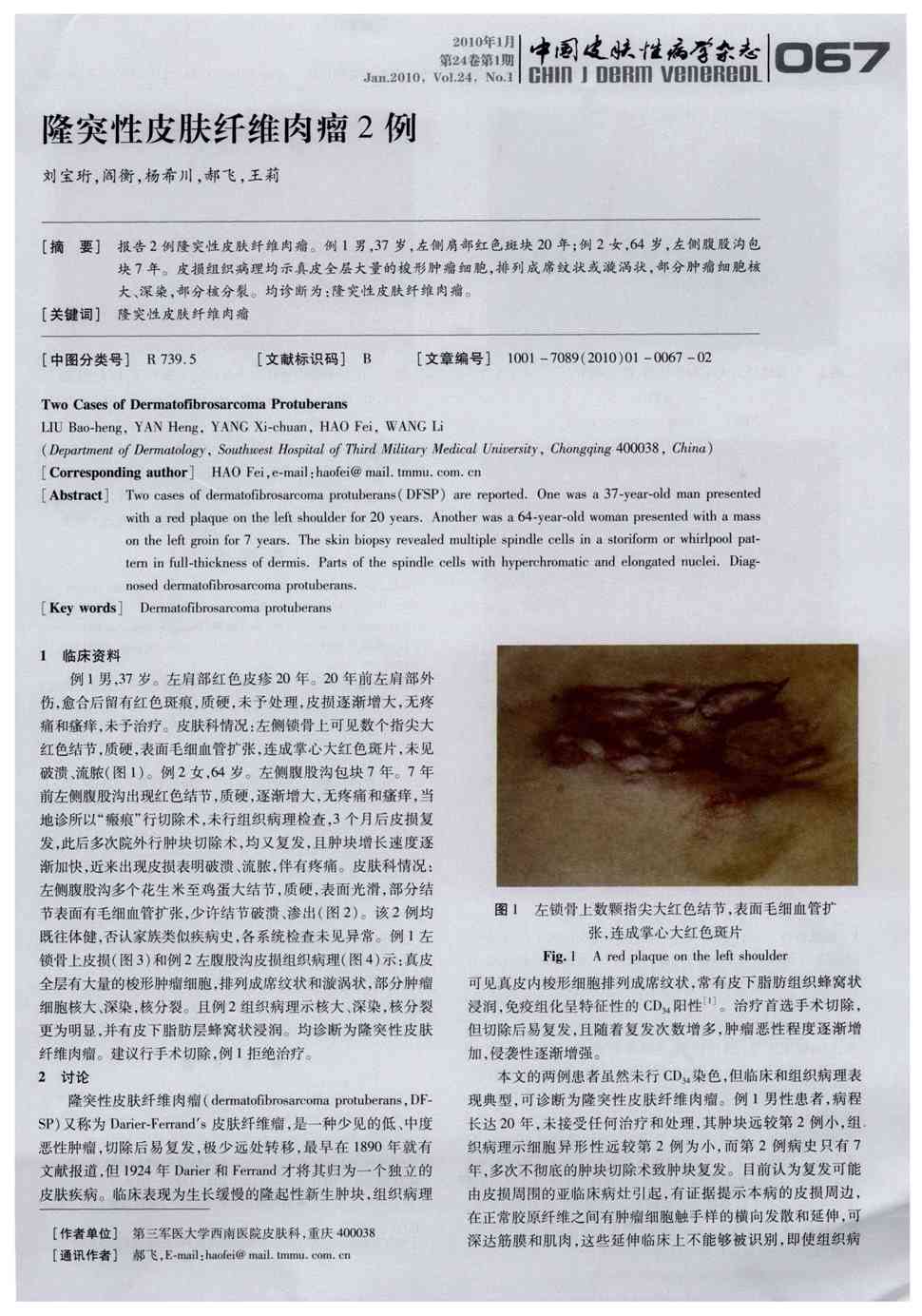 期刊隆突性皮肤纤维肉瘤2例被引量:6       报告2例隆突性皮肤纤维